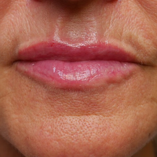 NA lipfiller
