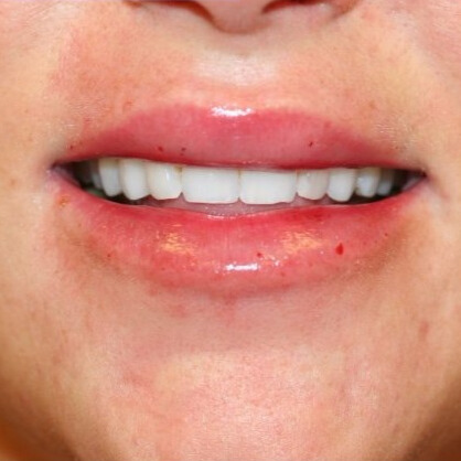 NA lipfiller