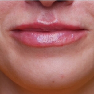 NA lipfiller