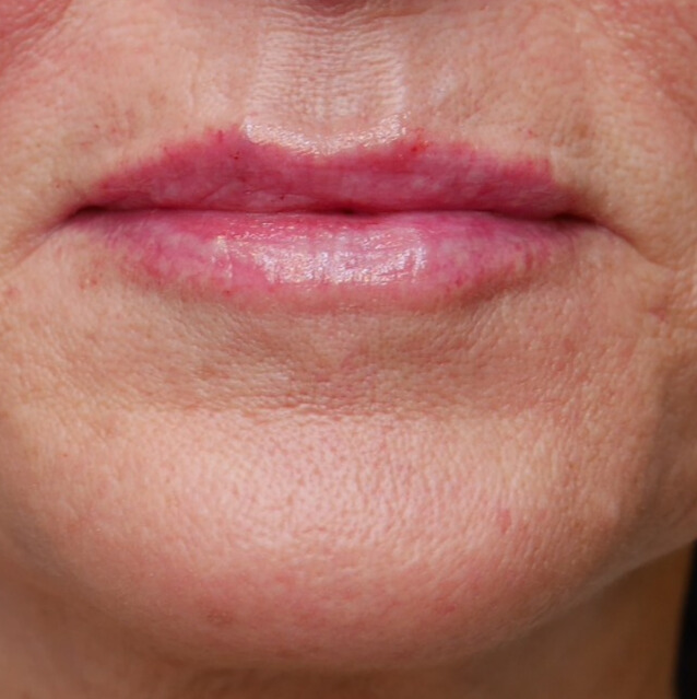 NA lipfiller