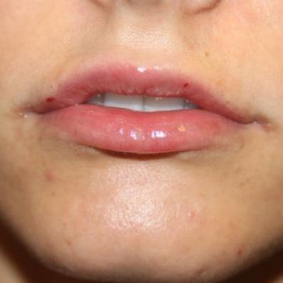 NA lipfiller