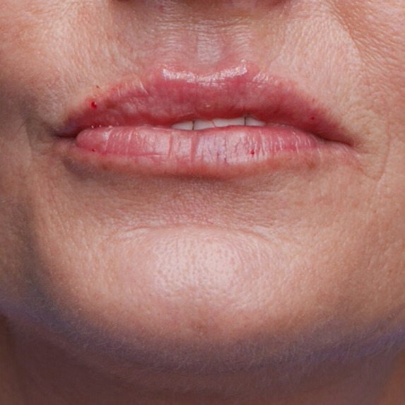 NA lipfiller