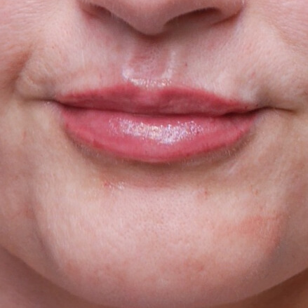NA lipfiller injectie