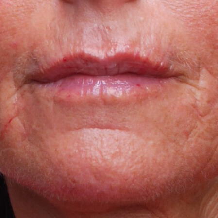 NA lipfiller injectie