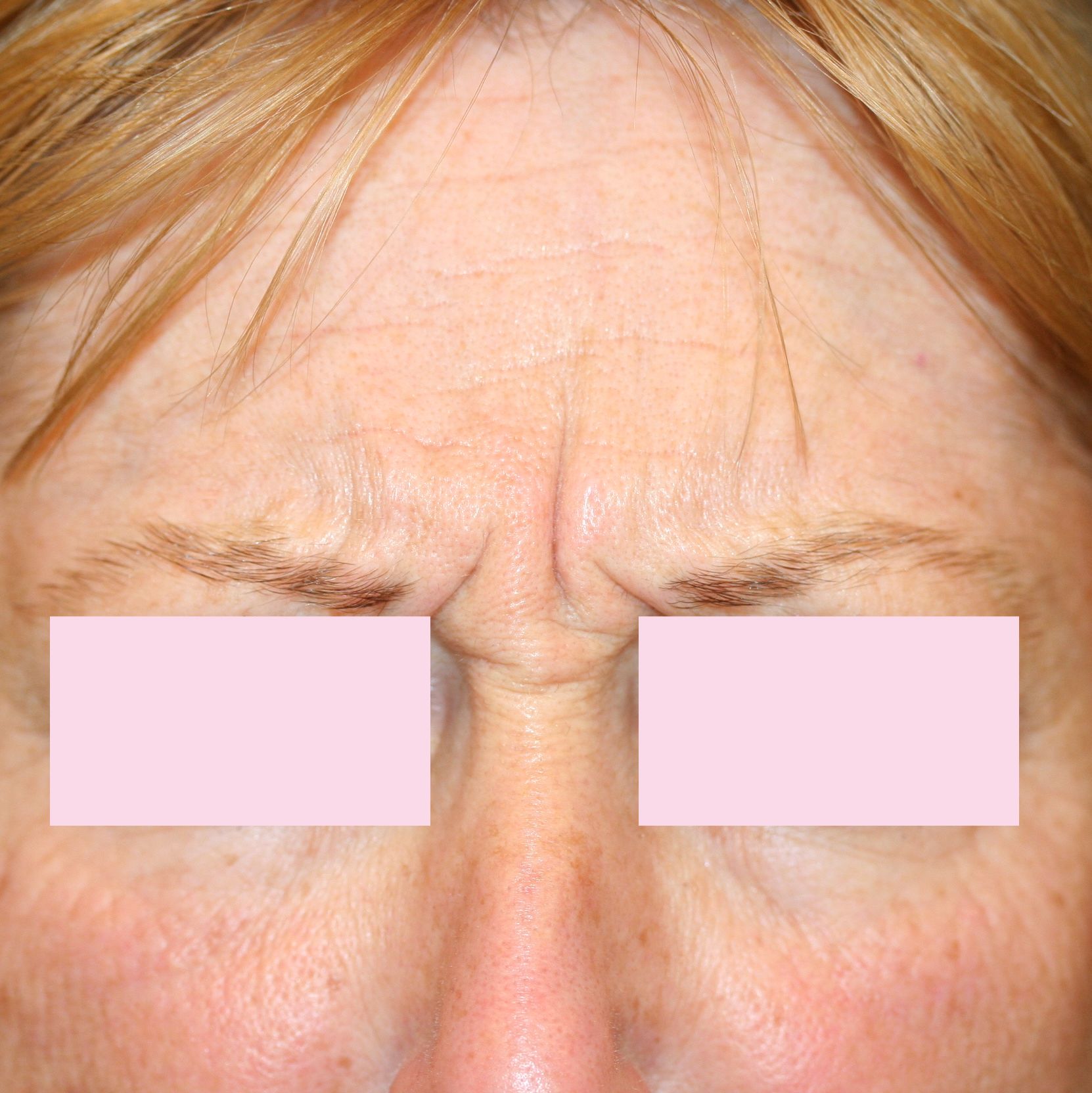 VOOR botox frons