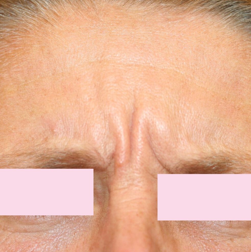 VOOR botox frons