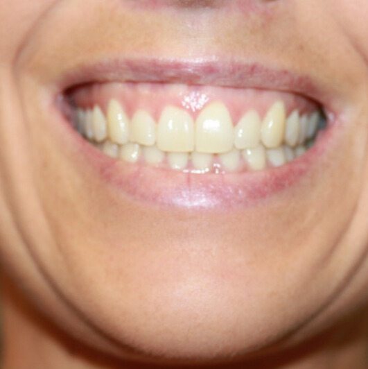 VOOR botox gummy smile