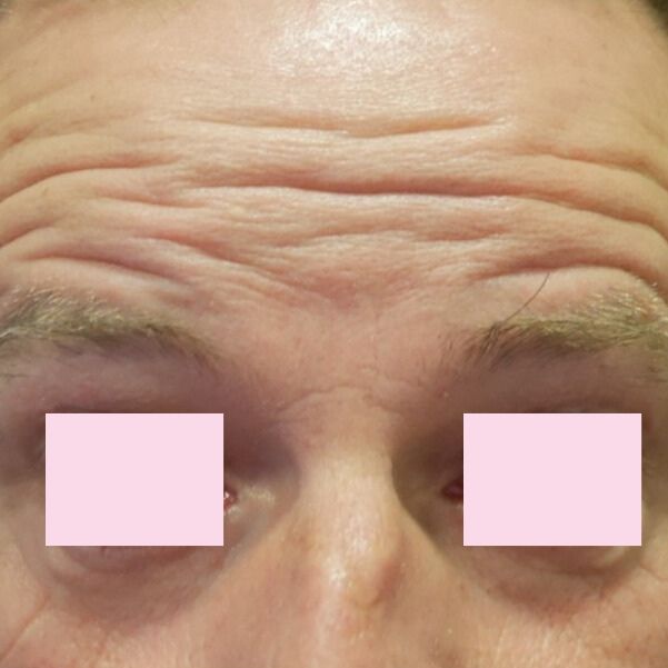 VOOR botox man voorhoofd