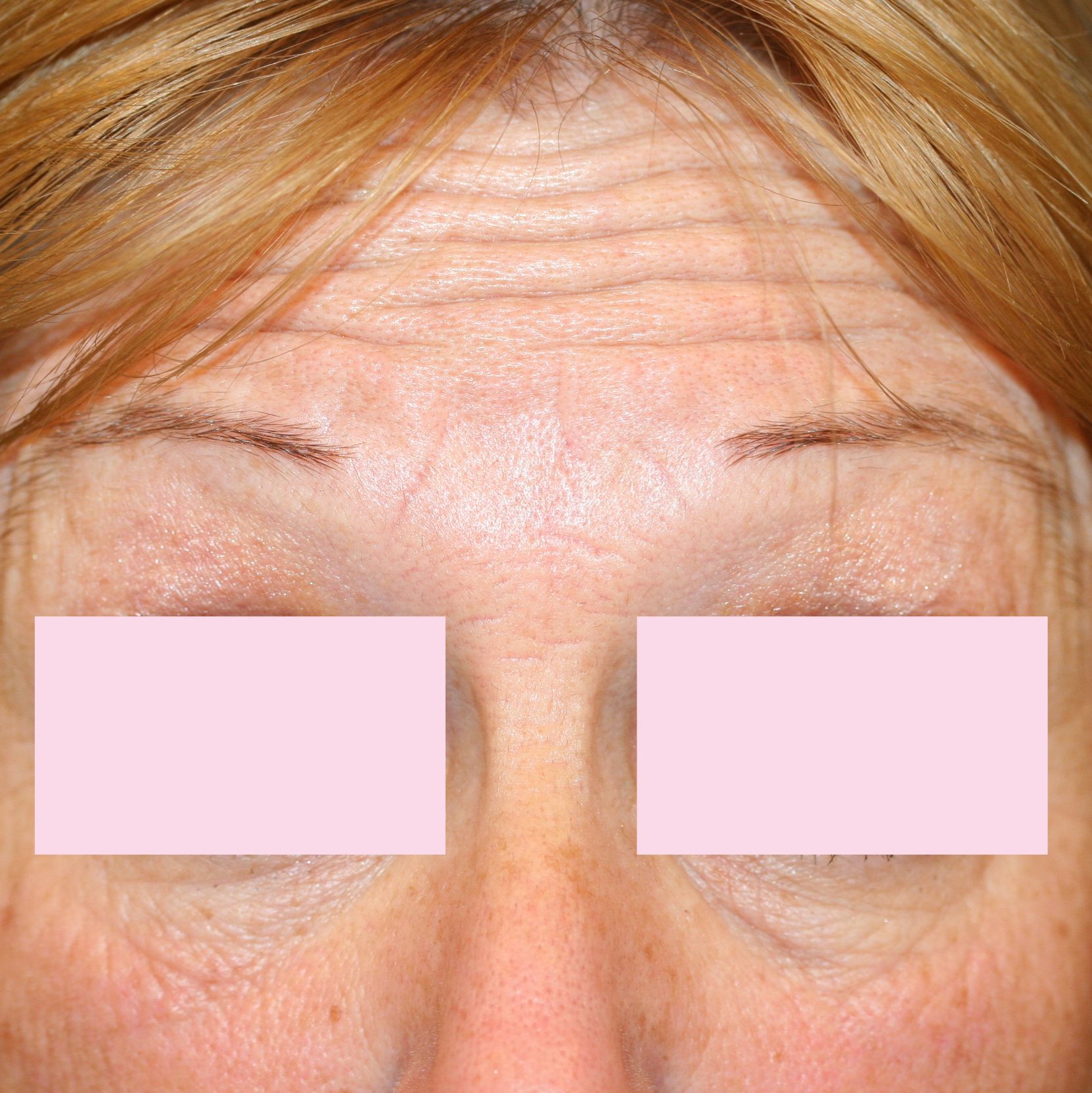 VOOR botox voorhoofd