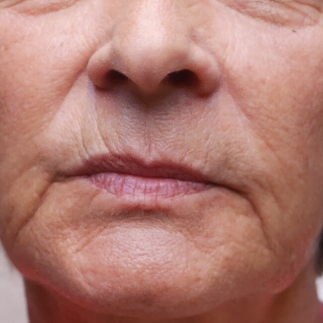 VOOR filler lips, mondhoek en wangen VOOR filler lips, mondhoek en wangen