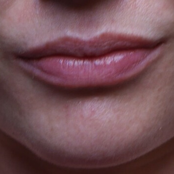 VOOR lipfiller