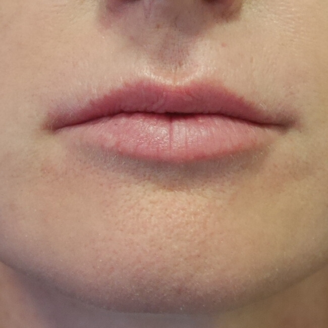 VOOR lipfiller