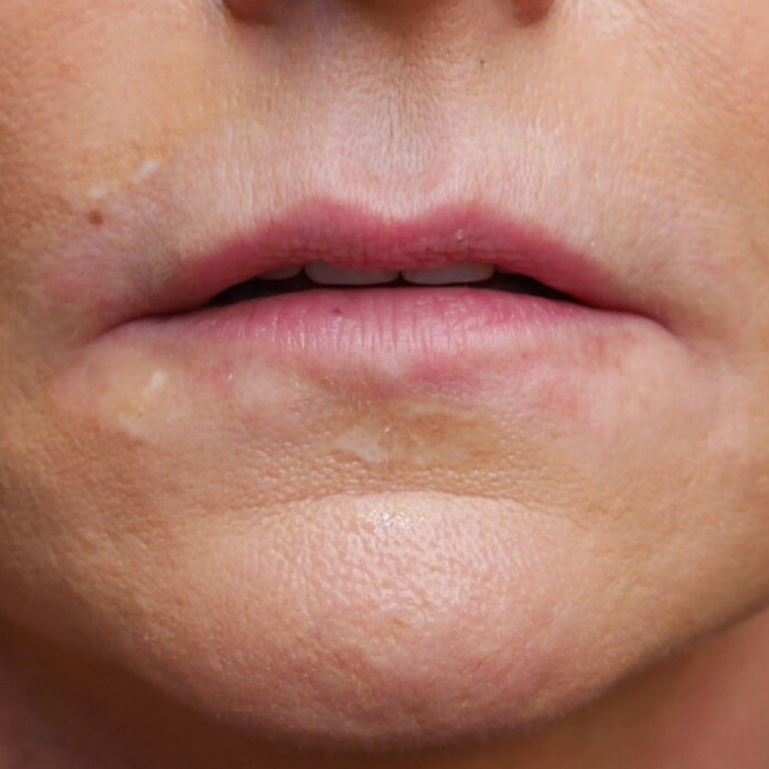 VOOR lipfiller