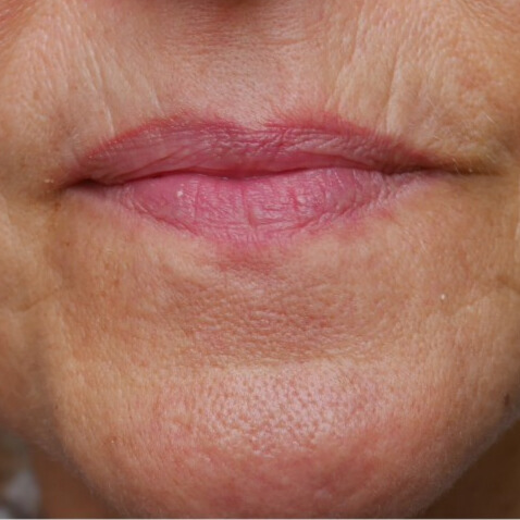 VOOR lipfiller
