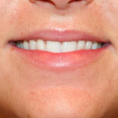 VOOR lipfiller