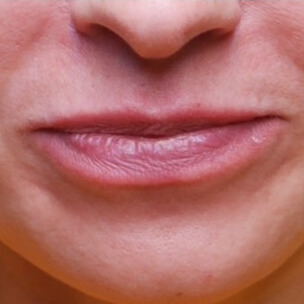 VOOR lipfiller