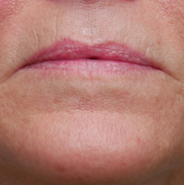 VOOR lipfiller