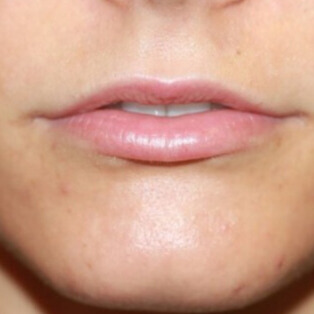 VOOR lipfiller