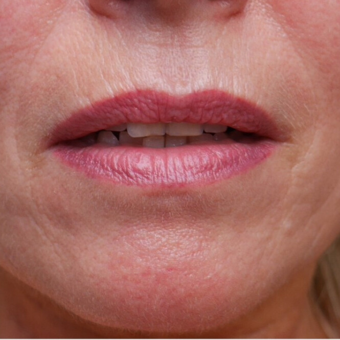 VOOR lipfiller contour en plooirokje