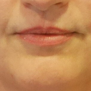 VOOR lipfiller injectie