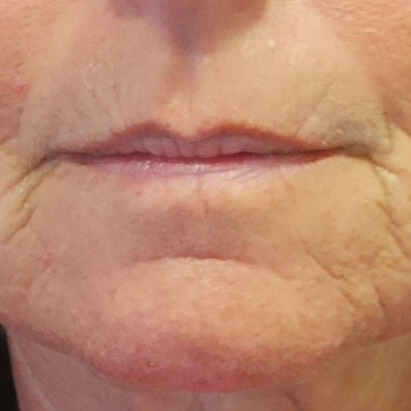 VOOR lipfiller injectie