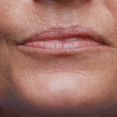 voor lipfiller