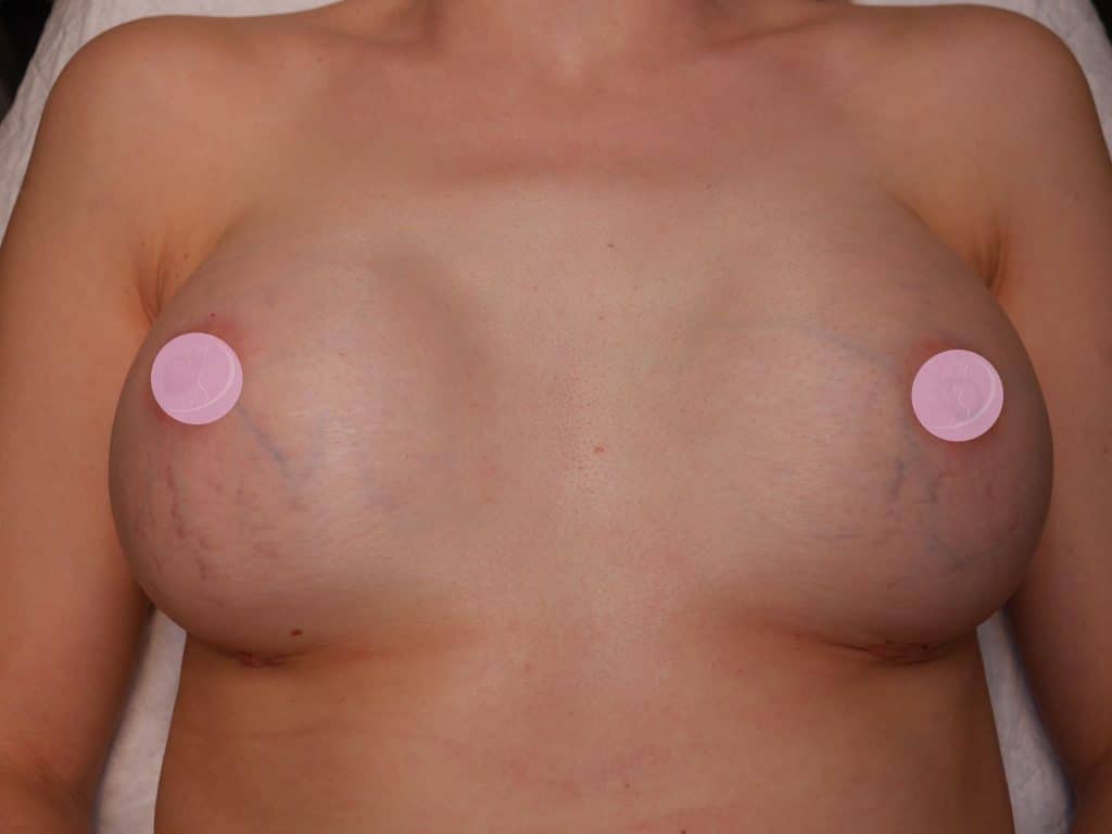 Litteken Preserve borstvergroting na 20 dagen