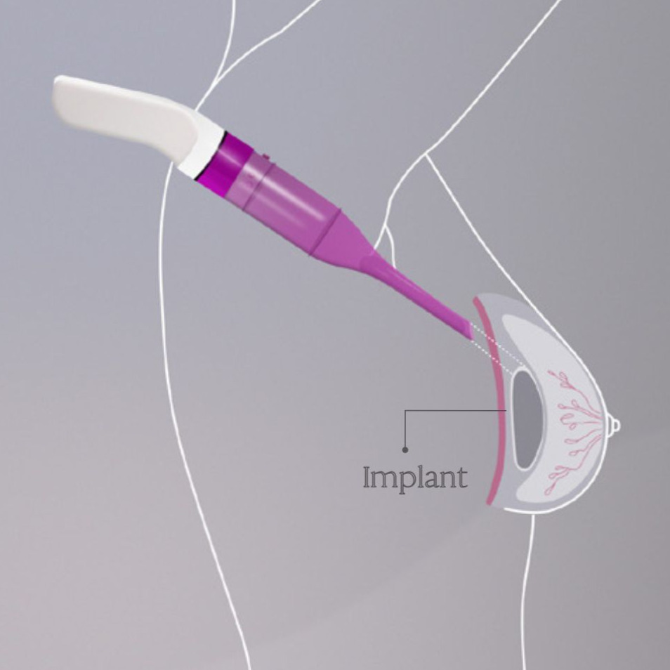 Step 3 Mia Femtech @globalcareclinic