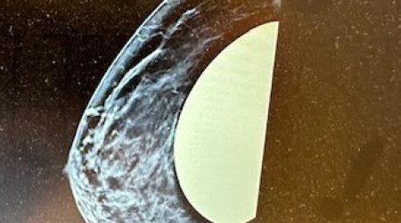 Mammografie na borstvergroting