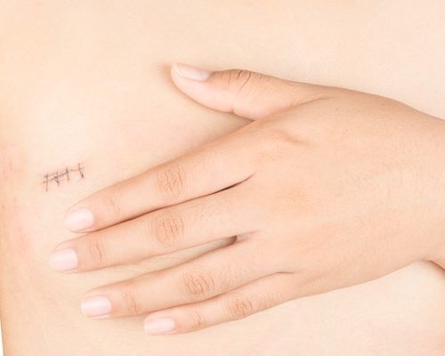 Littekencorrectie Global Care Clinic